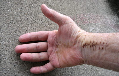 Wrist without bandage