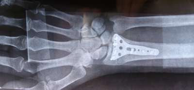 X-ray of plate in wrist