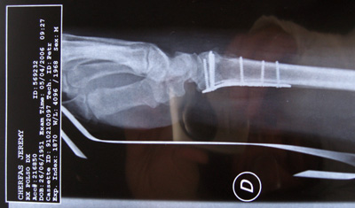 Another x-ray of wrist