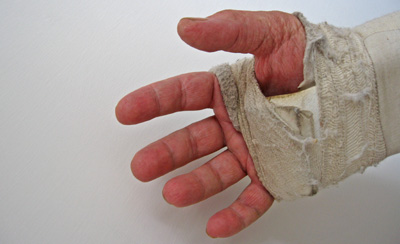 Bandaged wrist